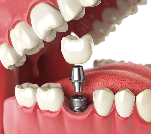 Phoenix Will I Need a Bone Graft for Dental Implants