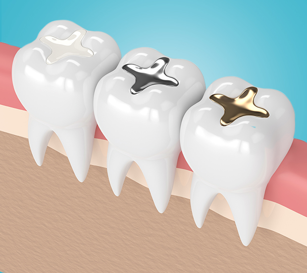 Phoenix Composite Fillings