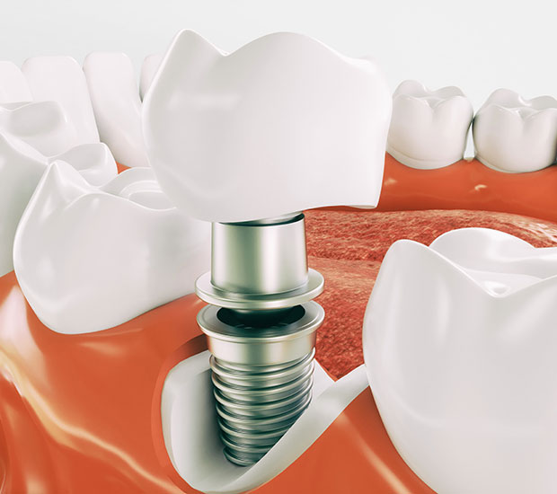 Phoenix Dental Implant Restoration