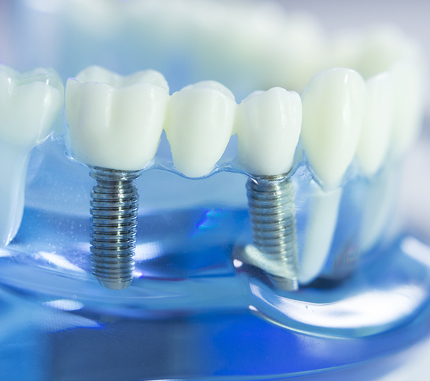 Phoenix Dental Implants
