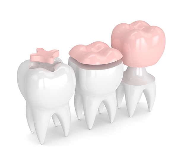 Phoenix Dental Inlays and Onlays