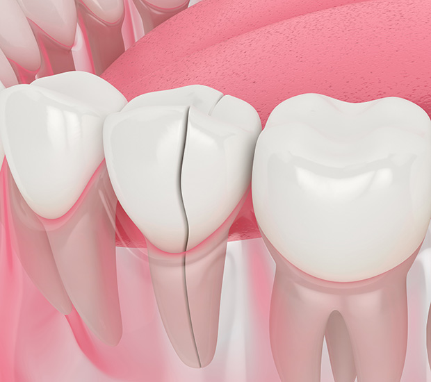 Phoenix Types of Dental Root Fractures