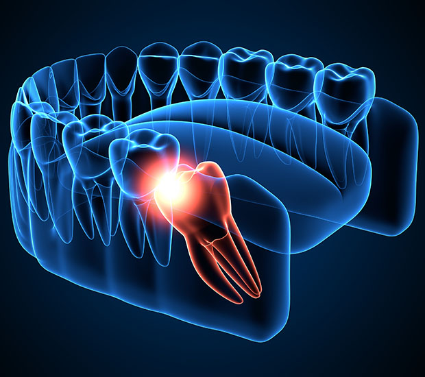 Phoenix Wisdom Teeth Extraction